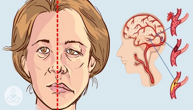 Bệnh tai biến mạch máu não biểu hiện như thế nào?