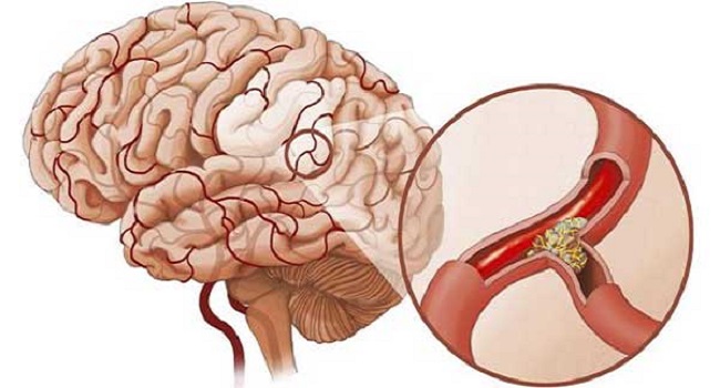 Bệnh tai biến mạch máu não là gì và cách điều trị như thế nào?