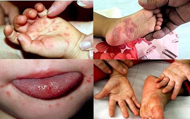 Biến chứng của bệnh sốt xuất huyết