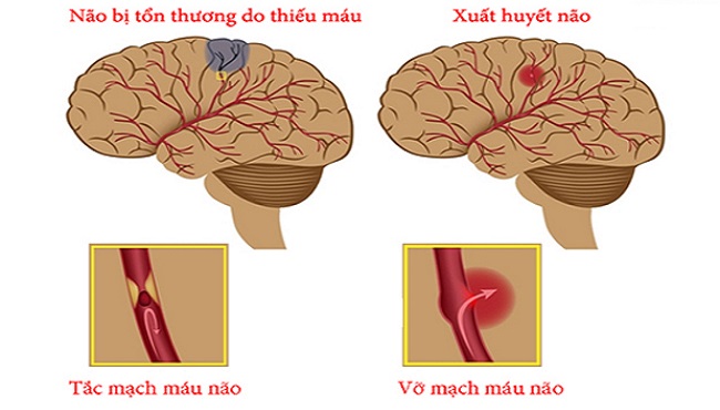 Bệnh tai biến mạch máu não là gì và cách điều trị như thế nào?